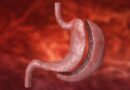 Gastrectomía tubular: ¿en qué consiste?