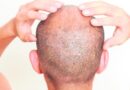 Científicos japoneses logran producir folículos de cabello para combatir la calvicie » Red De Noticias