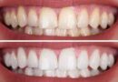 nqueamiento dental LED: ventajas, desventajas y cuidado